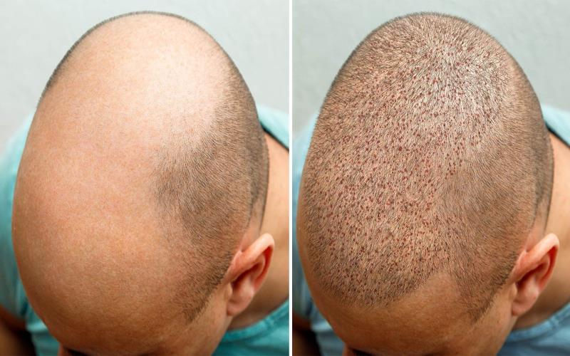 The Long-Term Benefits Of Investing In A Hair Transplant